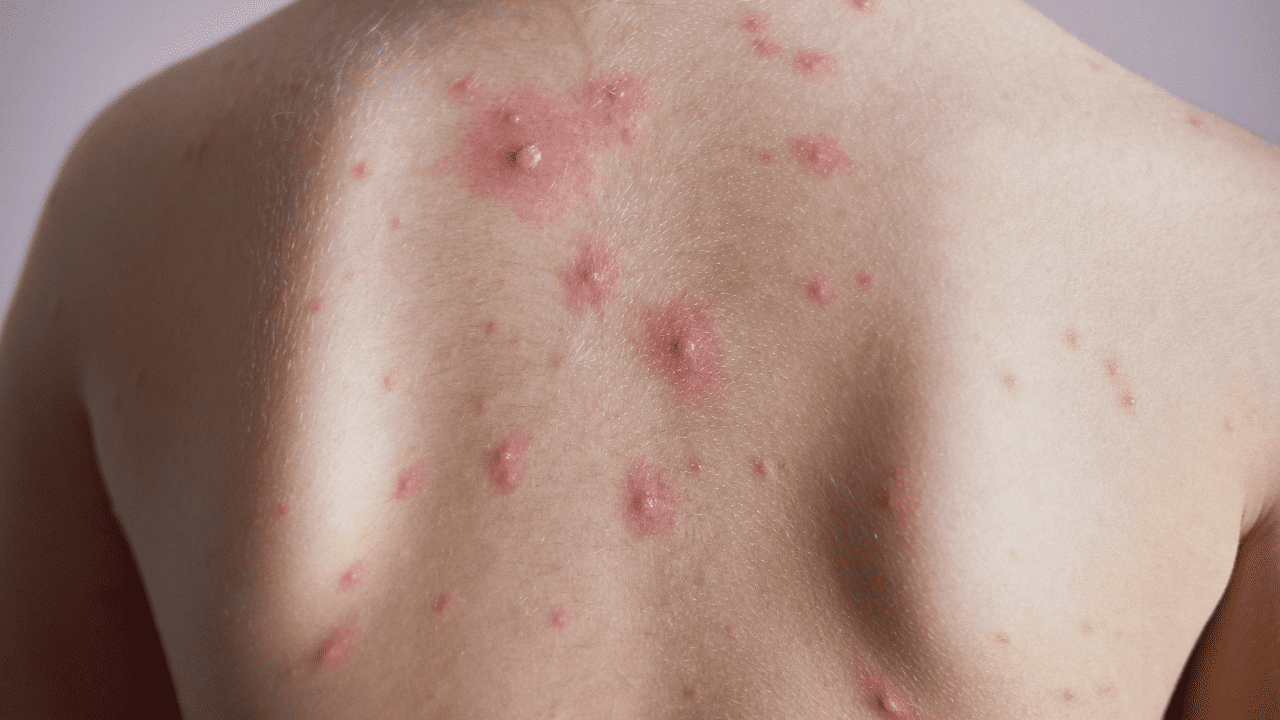 New Chickenpox Variant Found in India: What Does This Mean for You?