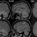 genetic basis of migraine subtypes