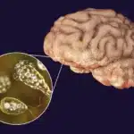 Brain-eating amoeba case in Arizona