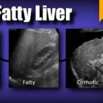 Fatty Liver Checked