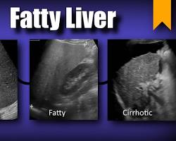 I Was Terrified to Get My Fatty Liver Checked - But It's a Good Job I Did 1 liver