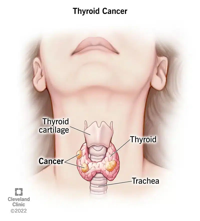 12210 thryoid cancer