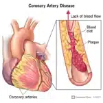 1 in 6 Coronary Artery Patients Have Heart Problem