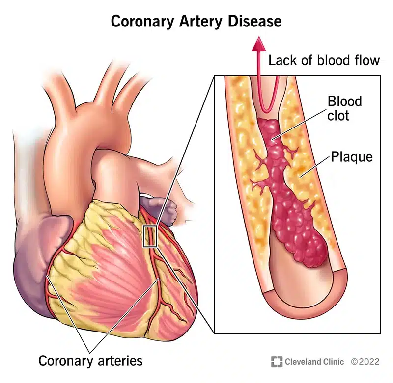 16898 coronary artery disease