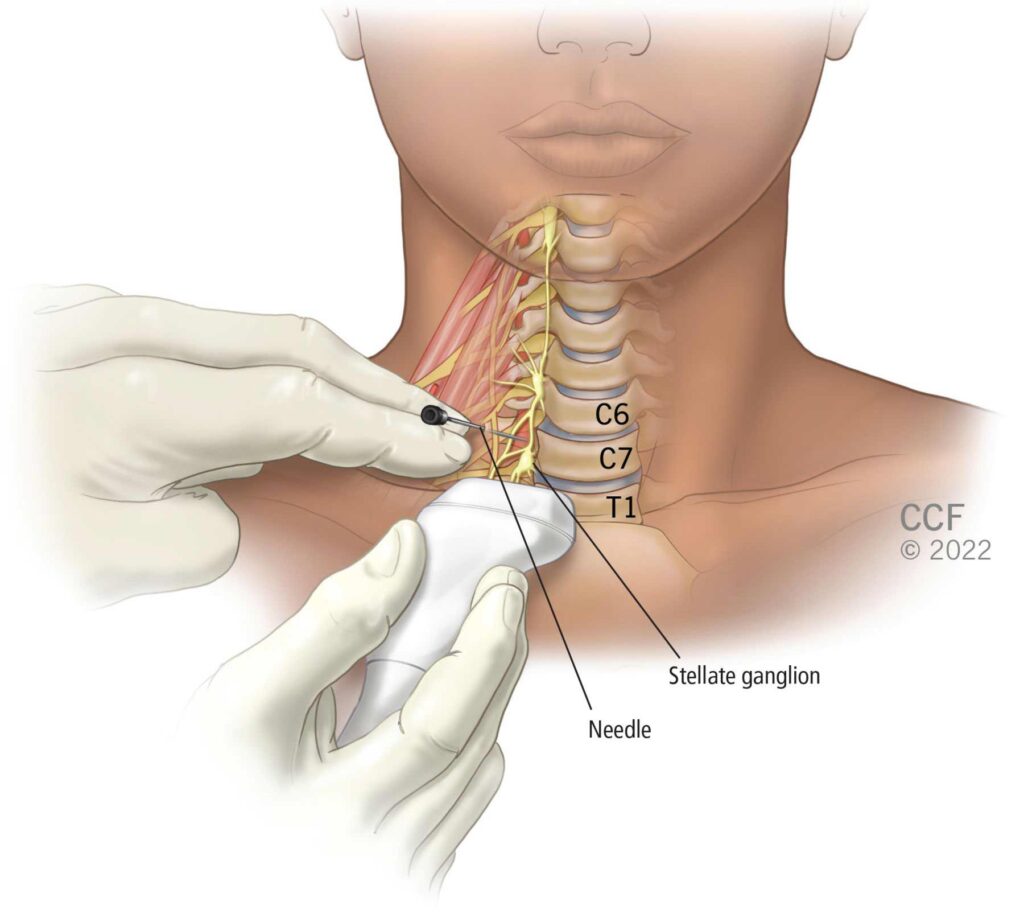 Restore Olfactory Function with Stellate Ganglion Block