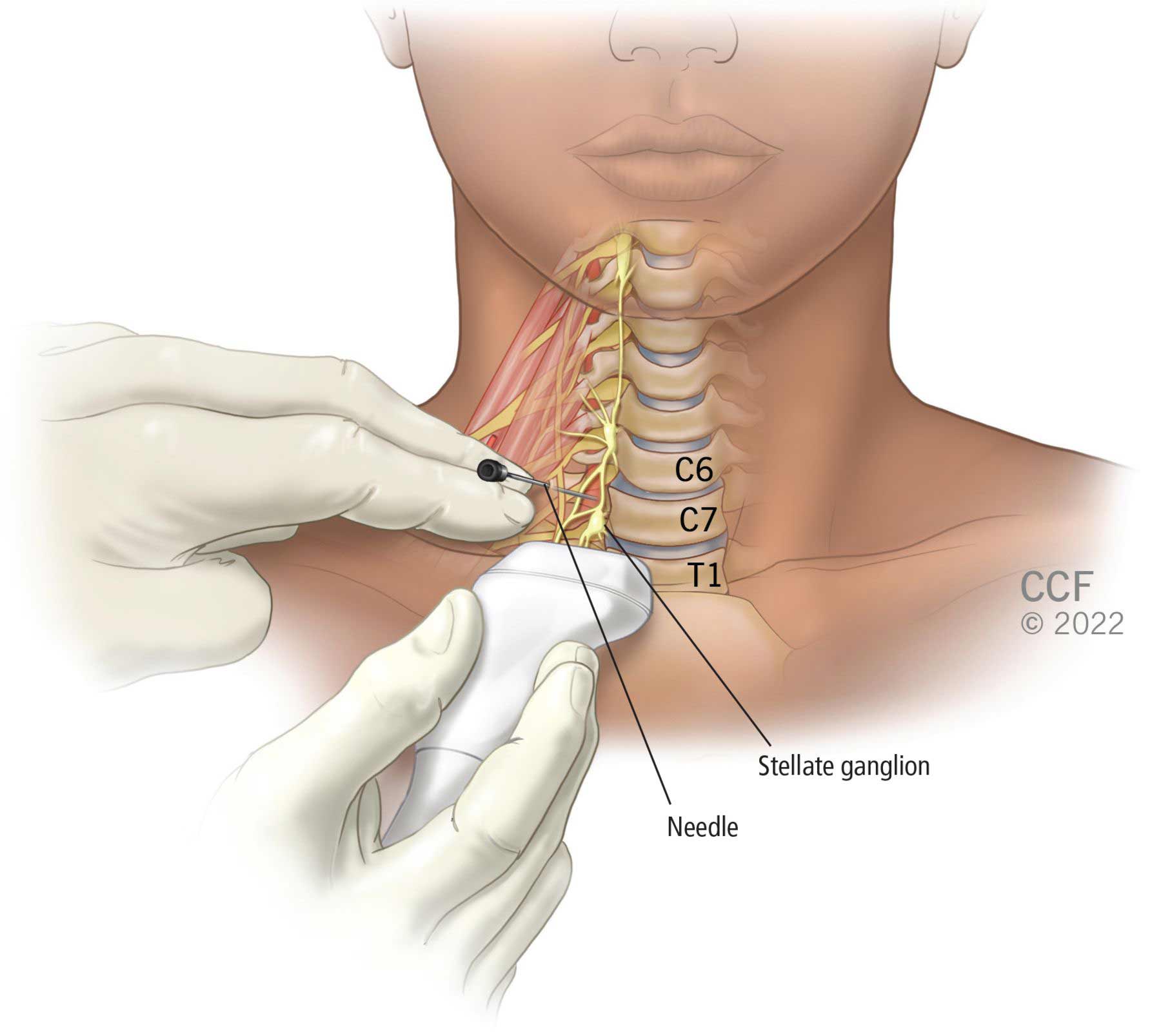 Smelling Hope: Can Stellate Ganglion Block Restore Lost Sense of Smell? (A New Dawn for Anosmia Sufferers)