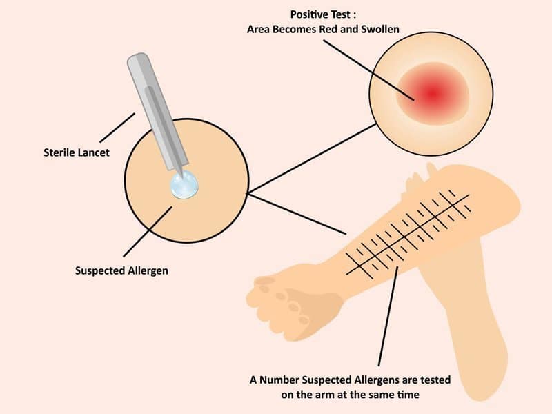 Skin Prick Test 2