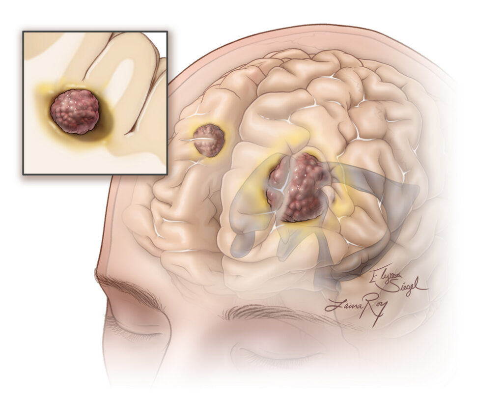 brain metastasis Fig 1