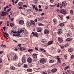 Melanoma brain metastasis pathway