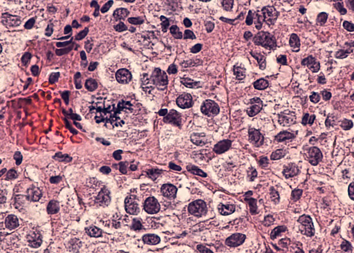 Melanoma brain metastasis pathway