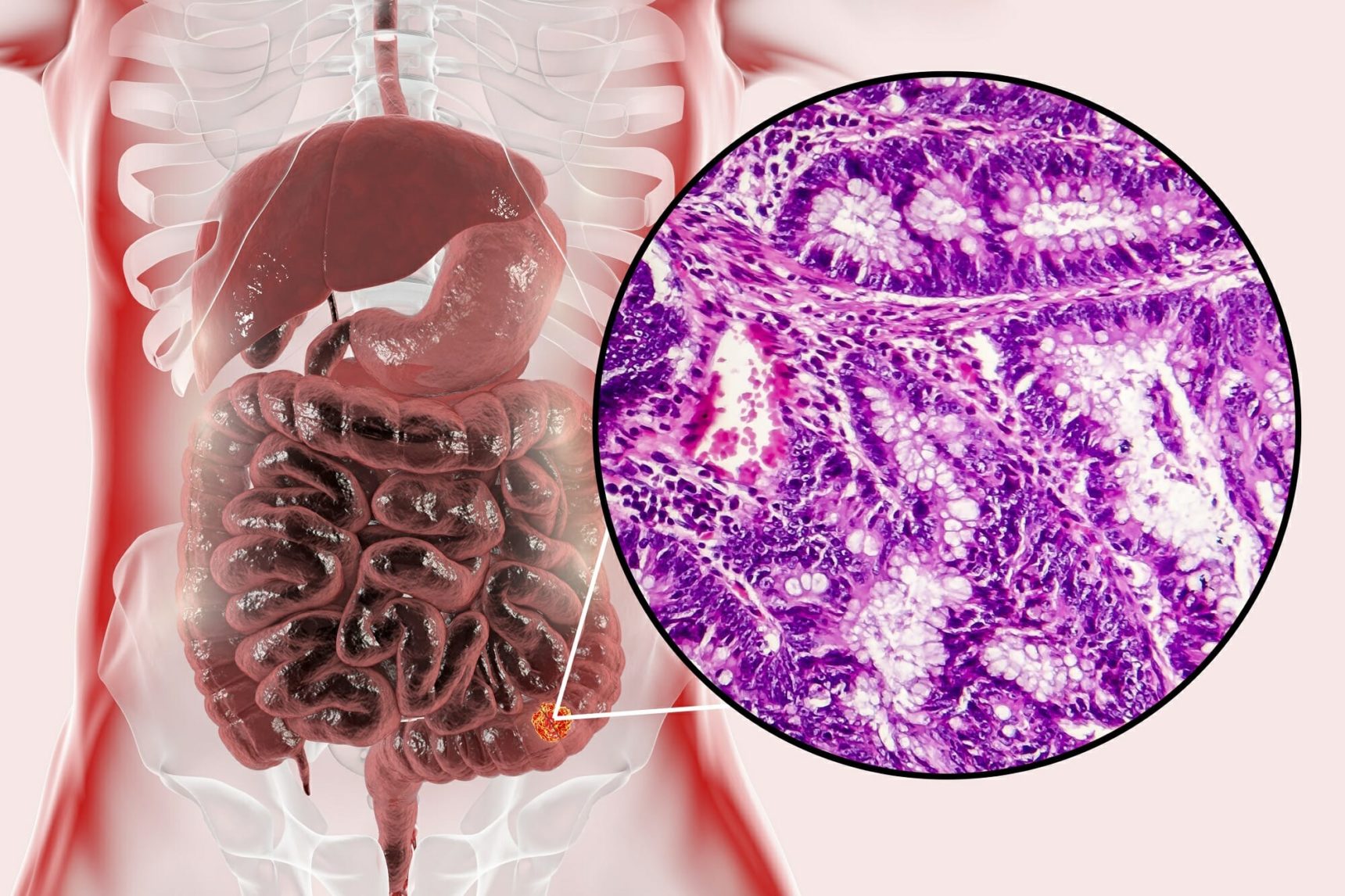 Colon Cleanse for Life? High-Quality Prep Boosts Colorectal Cancer Screening