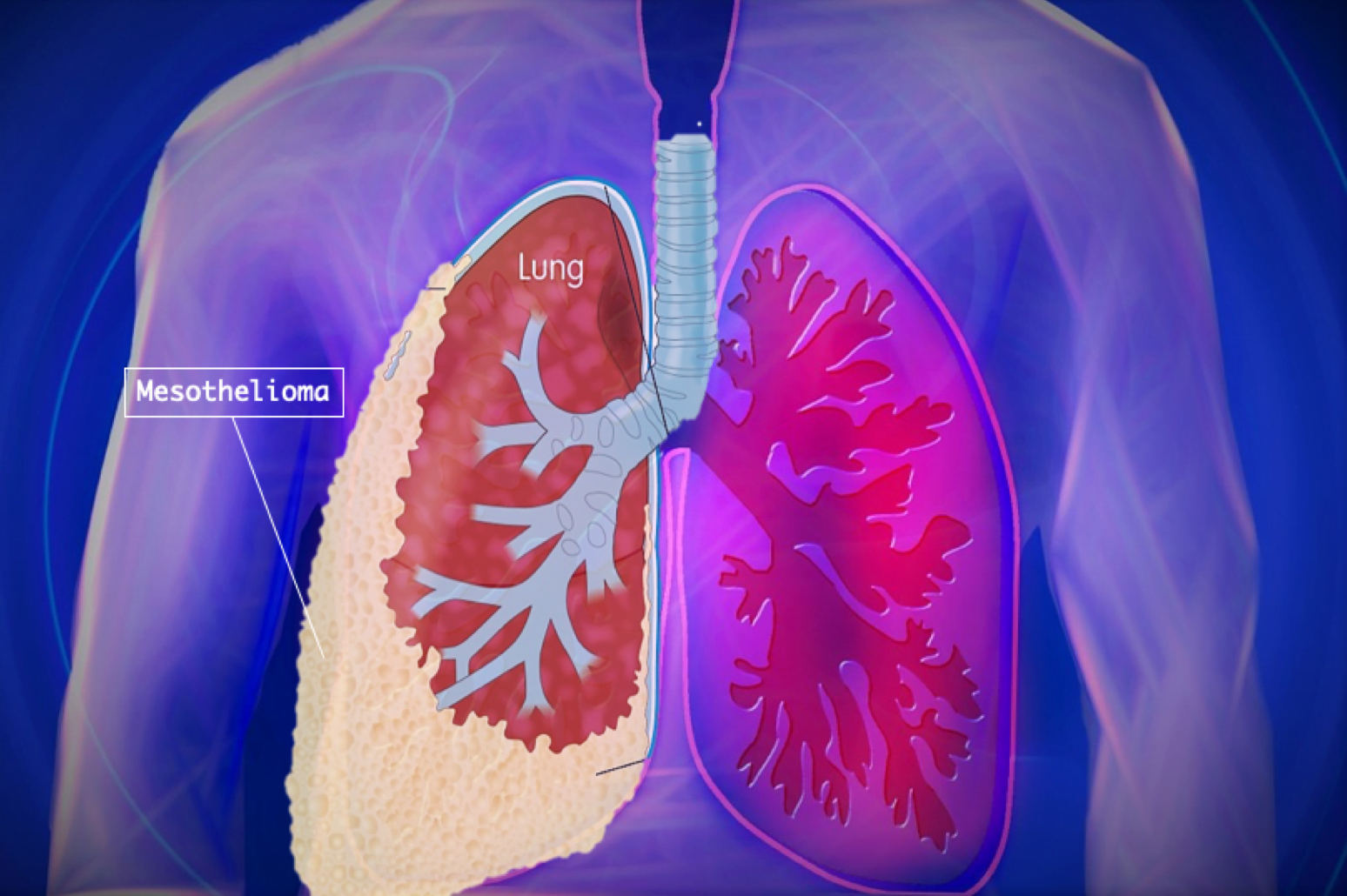 Mesothelioma Treatment Breakthrough