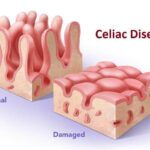 E551 Coeliac Disease