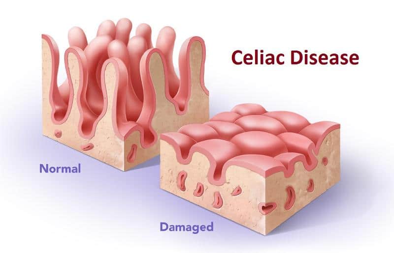 E551 and Coeliac Disease: Separating Fact from Fiction