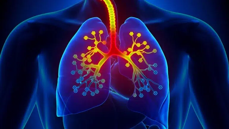CT Scan Detects Lung Cancer Mutation: AI Predicts Personalized Treatment Breakthrough