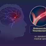 Thrombectomy Large Core Stroke