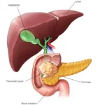 Pancreatic Cancer Early Signs