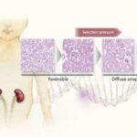 DA Wilms Tumor Chemotherapy Resistance