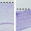 Familial Alzheimer's Disease Genetics