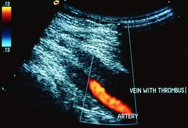 Getty rm dvt ultrasound