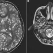 Neurocysticercosis