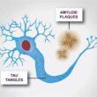 Amyloid and Tau in Alzheimer's