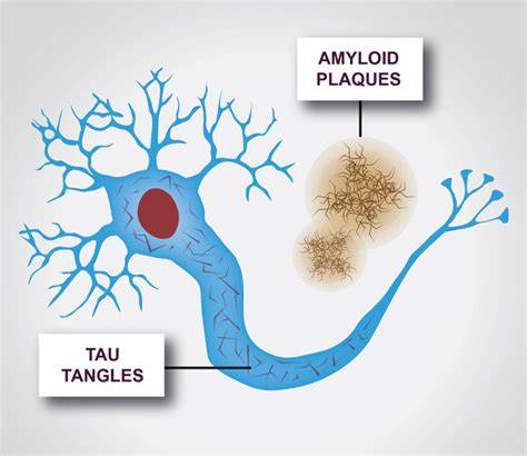 Alzheimer’s Disease: Unveiling the Mystery of Amyloid and Tau