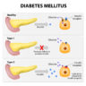 Types of Diabetes Explained