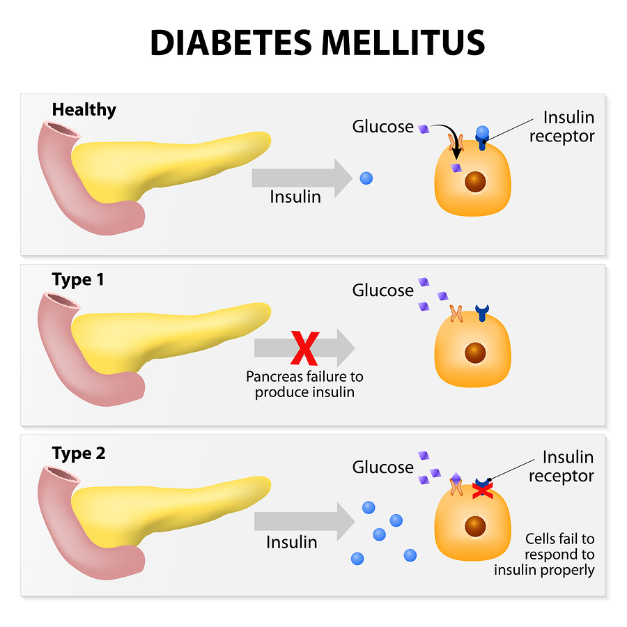 Type 1 vs. Type 2 vs. Gestational Diabetes: Understanding the Differences