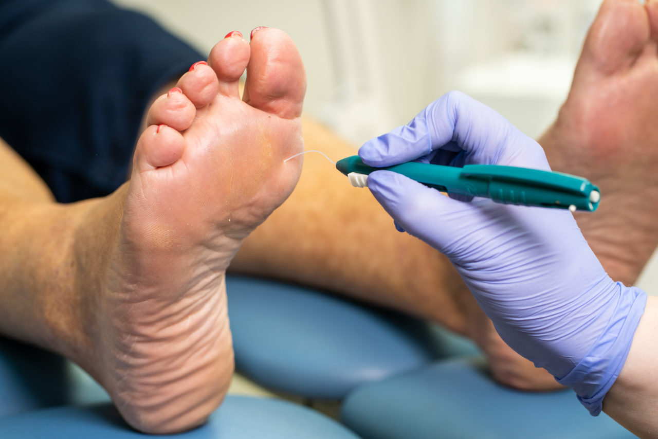 Diabetic Foot Care: Preventative Steps to Protect Your Feet and Avoid Complications