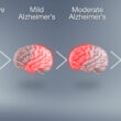 Stages of Alzheimer's Disease Progression