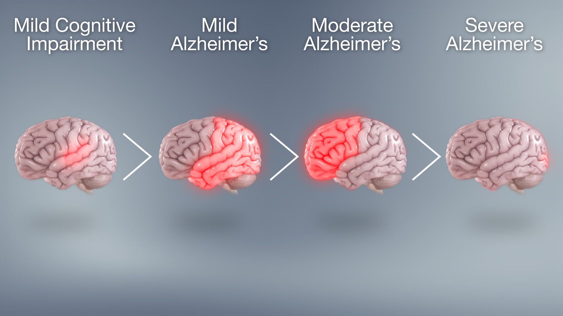 Alzheimer’s Disease Progression: A Guide to Understanding the Stages