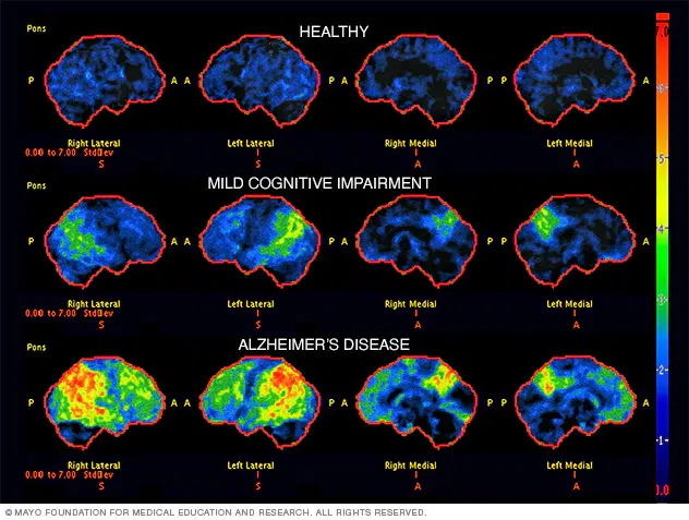 brain scan images for diagnosis of alzheimers 8 col 3161040 003 1