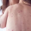 Michigan Measles Outbreak