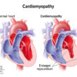 Cardiomyopathy