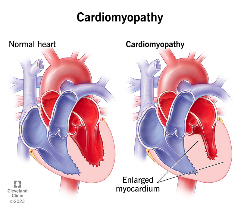 Cardiomyopathy Explained: Types (Dilated, Hypertrophic, Restrictive) & Treatment Options