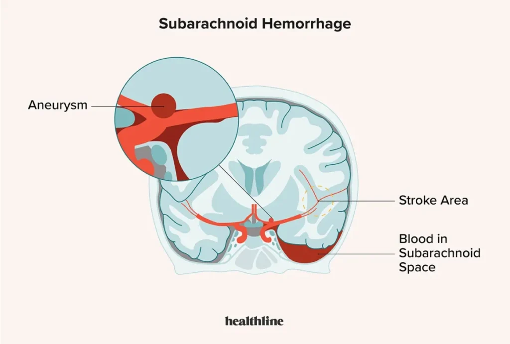 1747801 Subarachnoid Hemorrhage Overview 02