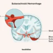 Subarachnoid Hemorrhage Symptoms and Treatment