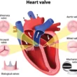 Heart Valve Disease