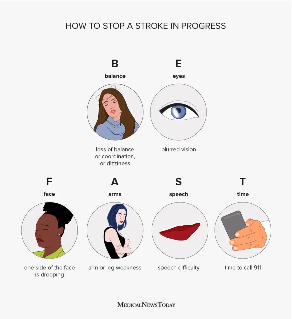 Stroke Warning Signs: Act FAST Before It’s Too Late