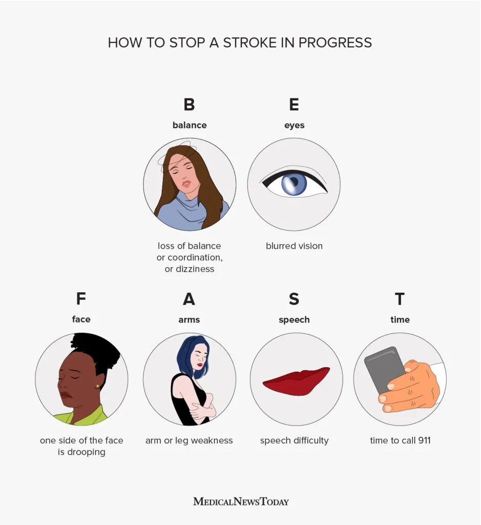 Stroke Warning Signs: Act FAST Before It's Too Late 1 2136041 FINAL CHECK DONE What does FAST stand for and what are the symptoms of a stroke Body Image 939x1024 1