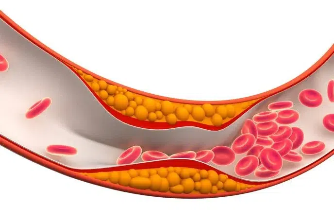 Atherosclerosis: Understanding Plaque Buildup and Preventing Clogged Arteries