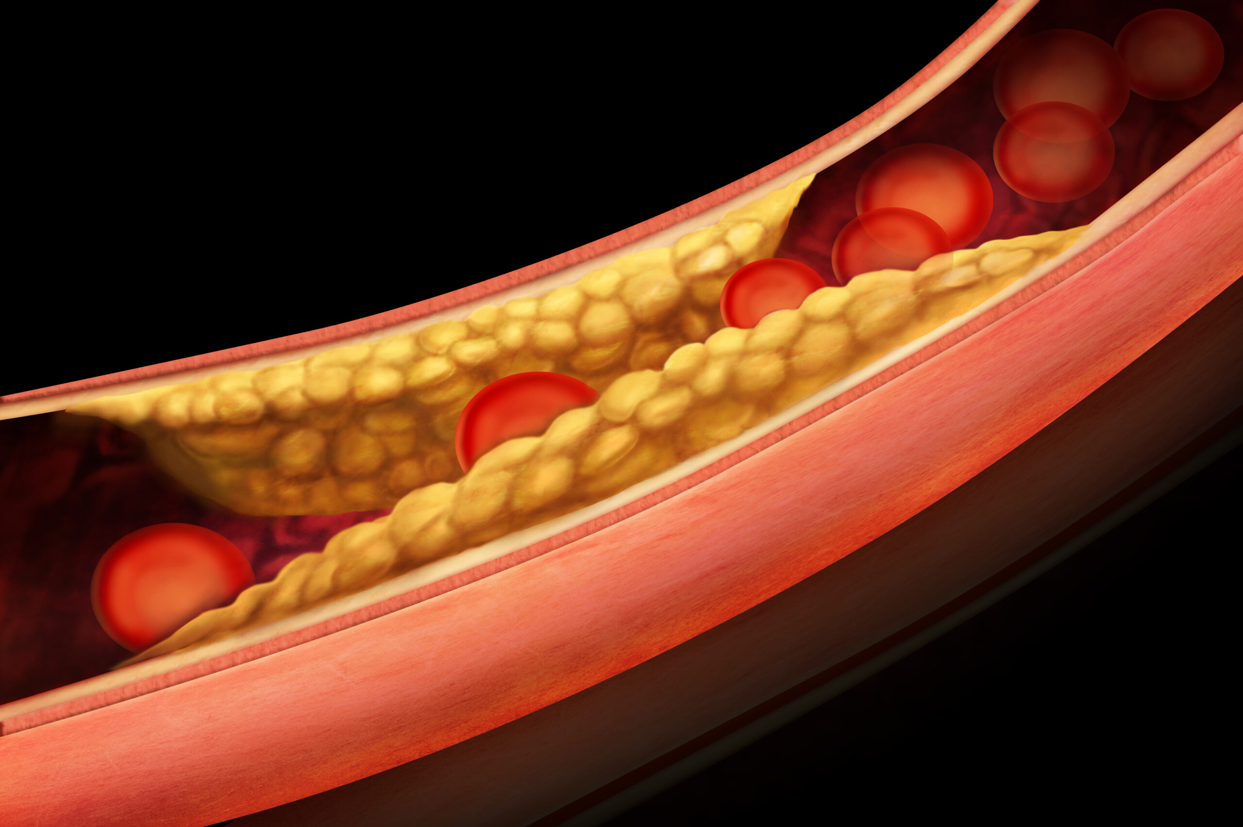 Atherosclerosis & Stroke Risk: How to Keep Your Arteries Clear