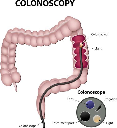 Colonoscopy 101: Your Guide to Colorectal Cancer Prevention
