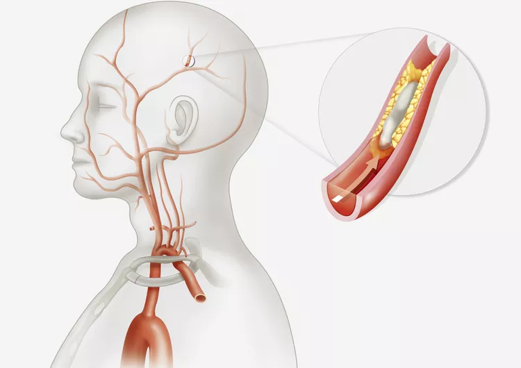 Thrombotic Stroke: FAST Action Saves Lives