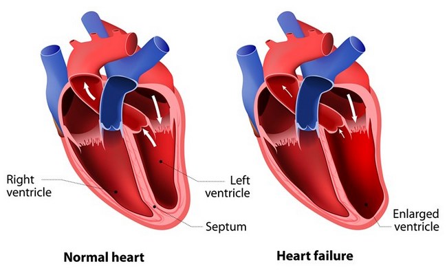 Heart Failure Explained: Types, Causes, Symptoms, and Treatment Options