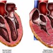 Hypertension and Heart Disease Risk