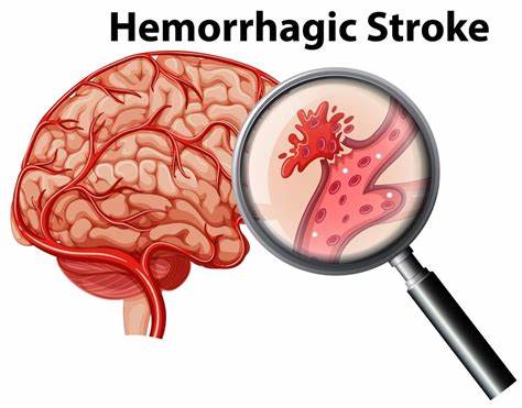 Hemorrhagic Stroke: Sudden Headache, Immediate Action