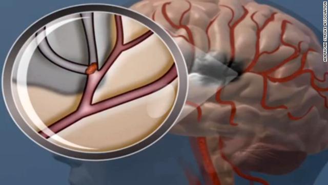 Stroke Explained: Definition, Types, Symptoms & Why Early Action Saves Lives