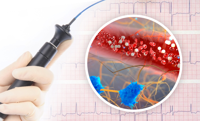 Blood Thinners for Atrial Fibrillation: Preventing Stroke with Anticoagulation Therapy